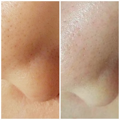 [分享] 果酸30趴浮粉超爽快