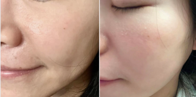 [分享] 藻針精華使用心得