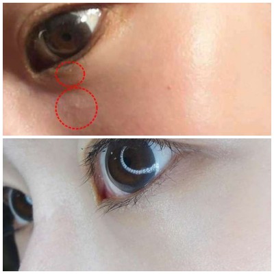 [分享] 眼周/頸部顆粒out