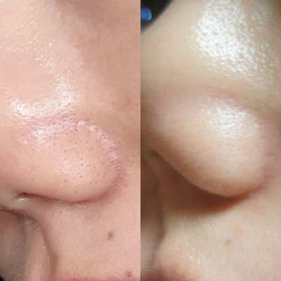 [分享] 告別惱人粉刺！這 3 招讓你的鼻頭潔淨無瑕！