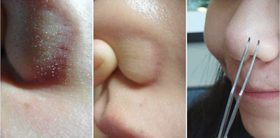 [分享] 別再怕青春痘！！秘訣都告訴你們了，還我蛋殼/水煮蛋肌膚，除粉,青春痘10大法則